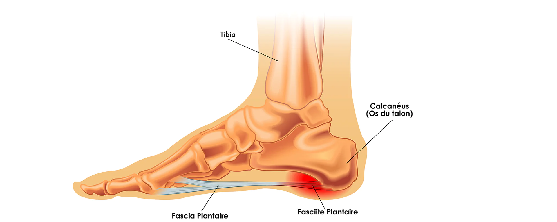 Schéma du pied : os du talon, fascia plantaire et zone douloureuse de la fasciite plantaire